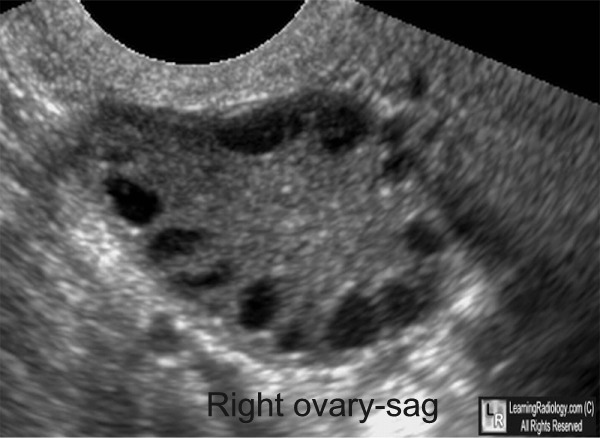 LearningRadiology Polycystic Ovary Syndrome, PCOS, Stein